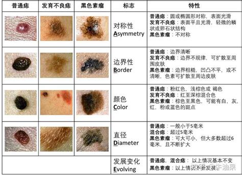 手臂有黑痣|这样的黑痣竟是“黑色素瘤”！医生：超过这个尺寸的黑。